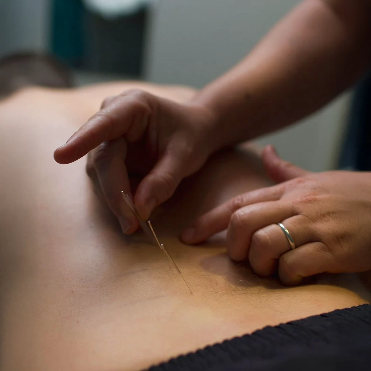 Acupuntura - Abordagem tradicional chinesa, usada como complemento ao tratamento da dor.
